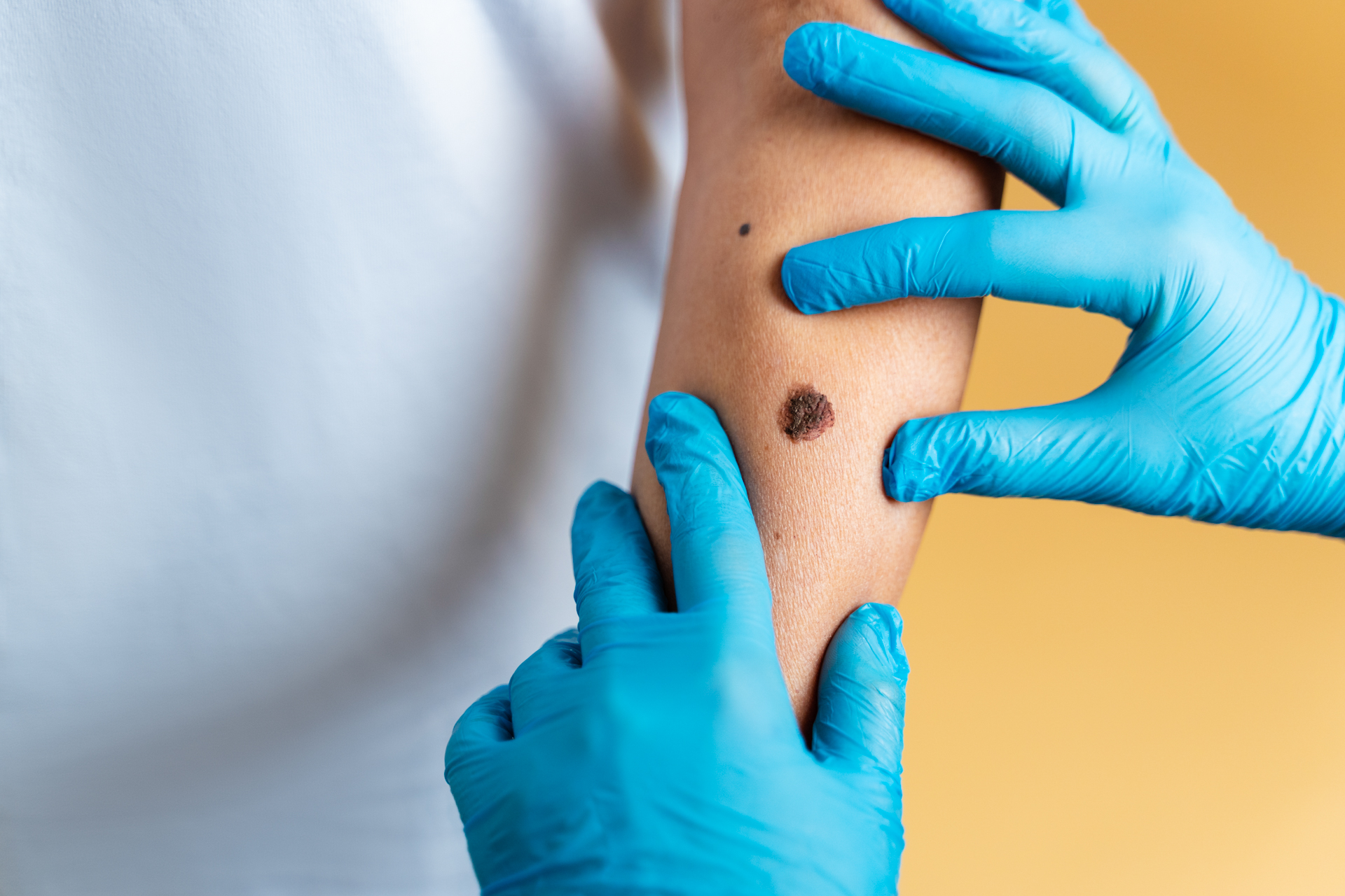 Mole Removal